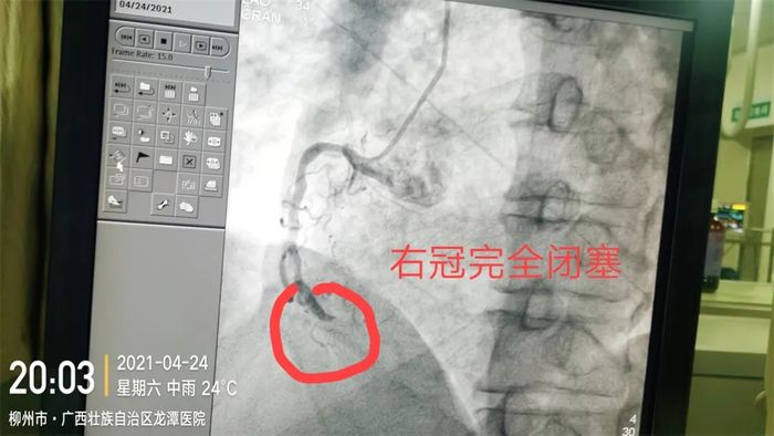 患者突发心梗！在这危急时刻…
