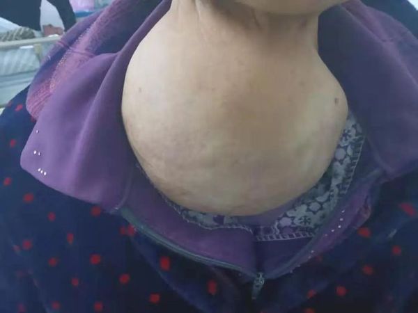 为病寻理，科学诊治 —广西龙潭医院多学科协作除巨瘤
