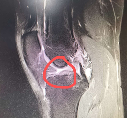致微于镜，妙手回春—广西龙潭医院骨外科成功实施关节镜微创手术延续他的绿茵梦