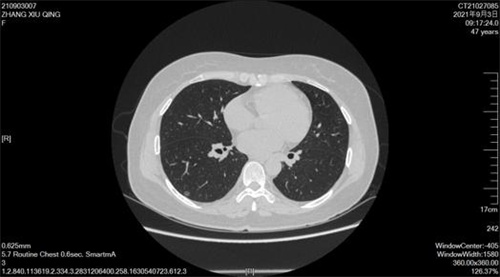 无管微创 安全升级——我院胸心外科成功实施一例艾滋病合并肺癌无管微创手术