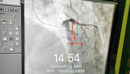 生死时速！又一例急性心肌梗死患者在我院获得重生