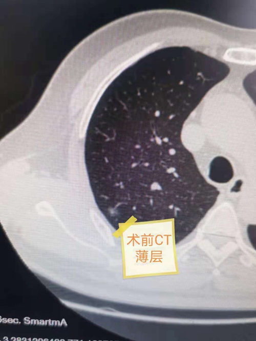 【技术创新】这波操作竟能让肺癌患者开胸术后即可下床活动