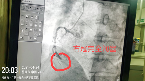 患者突发心梗！在这危急时刻…