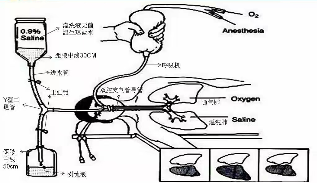 【健康科普】得了这些肺部疾病，这个技术可使“旧”肺换新