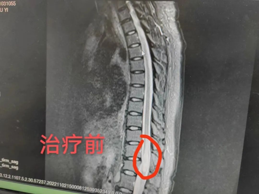 患上脊髓结核的她随时可能瘫痪，来到这里只吃药不手术就治好了